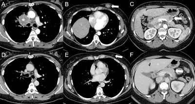 Tumor response assessment on imaging following immunotherapy